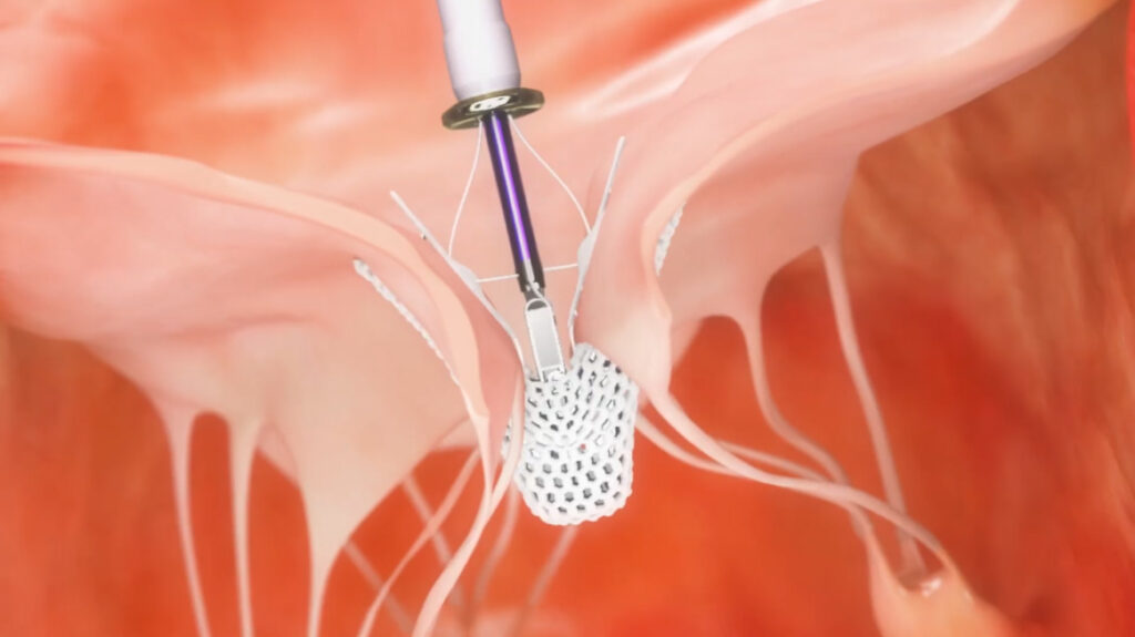 TriClip™ Procedure